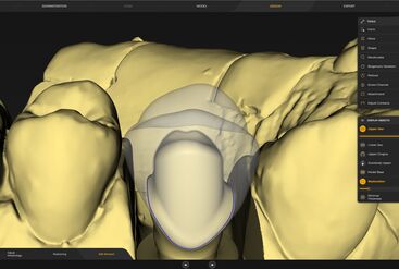 inLab CAD Software, Virtual insertion of a restoration