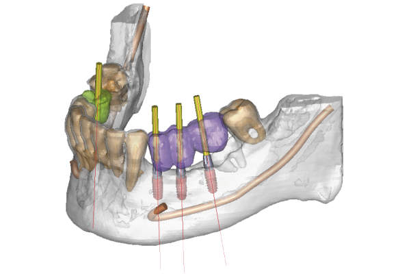 Simplant – Computer-guided treatment planning