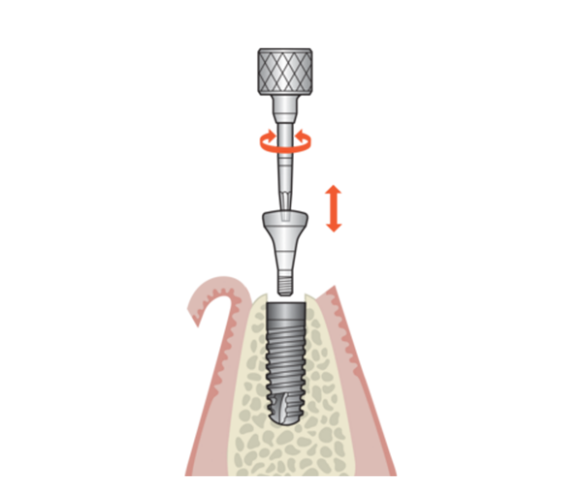 Transgingival healing