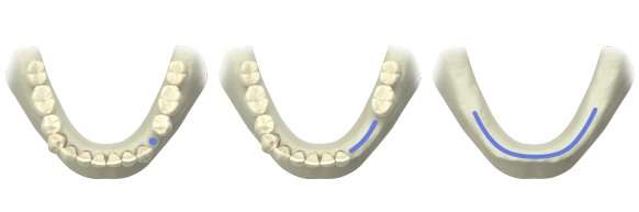 Atlantis patient-specific abutments