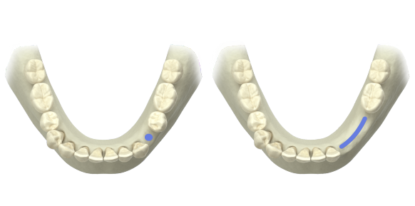 ZirDesign edentulous