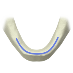 Splinted restorations in the mandible/maxilla in combination with bar