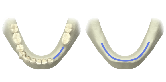 Angled Abutment