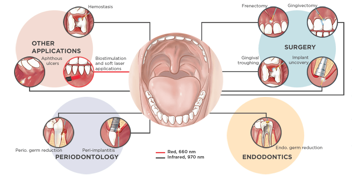 Treatment options SiroLaser Advance Plus