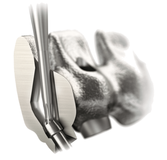 Optimal positioning of the screw access channel