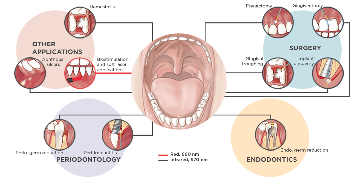 Treatment options SiroLaser Plus