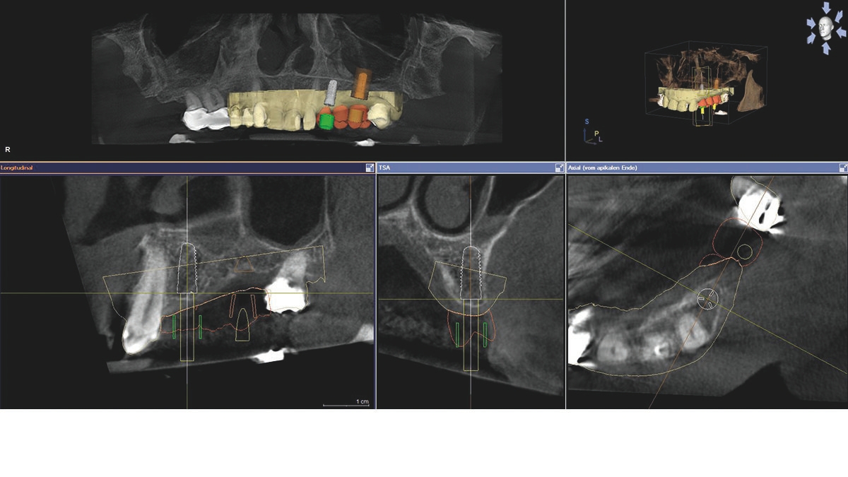 inLab CAD Software, optical scan in combination with 3D X-ray data