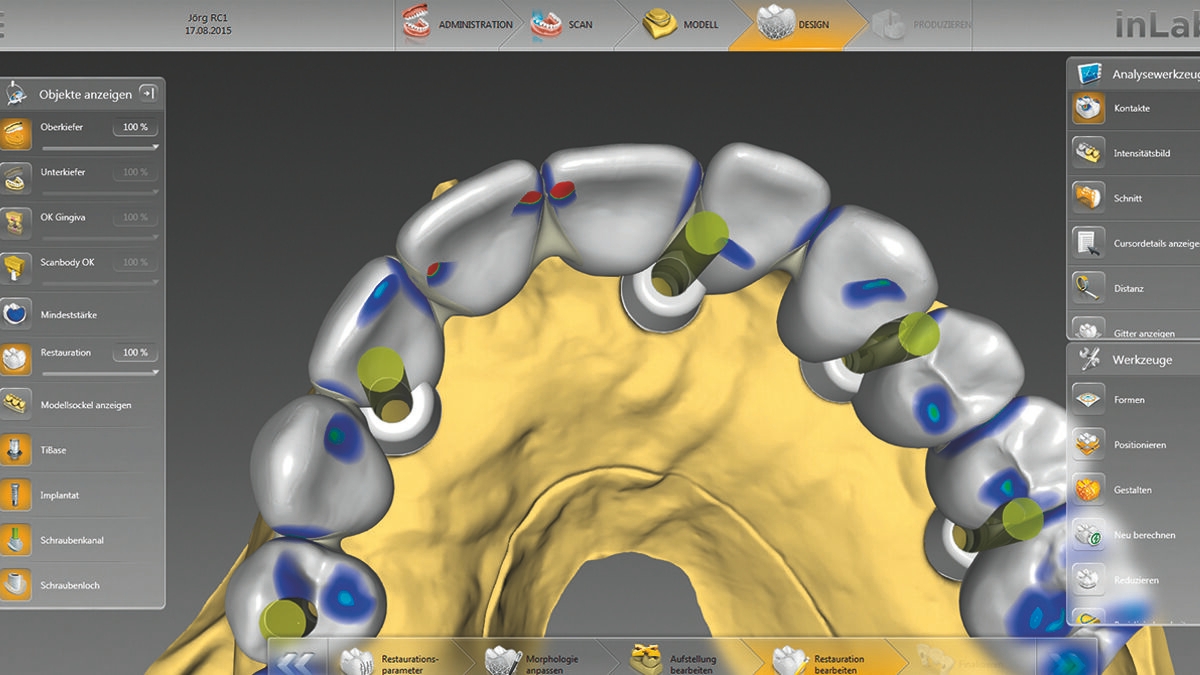 inLab CAD Software, superstructure construction