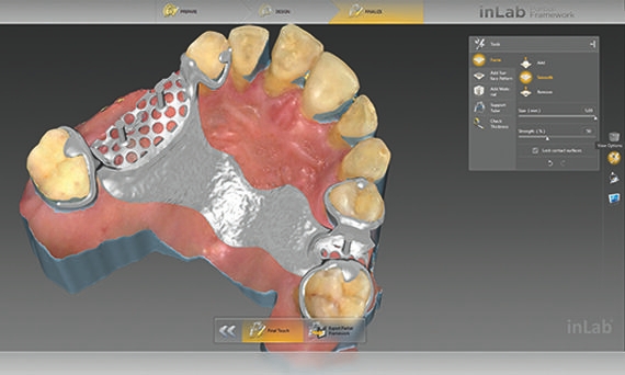 inLab CAD Software, individual adjustment of a removable denture prosthesis