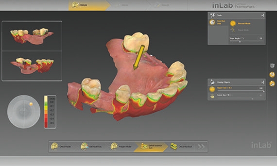 inLab CAD Software, display of undercuts