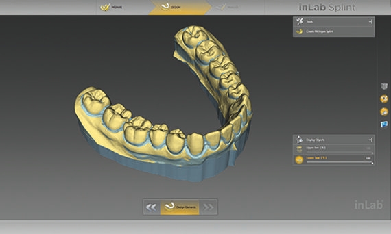 inLab CAD Software, visualization of undercuts on the digital cast
