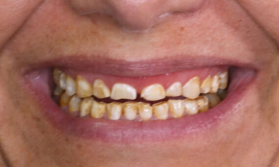 Tooth discoloration