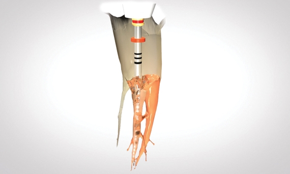 Removal of GuttaCore image