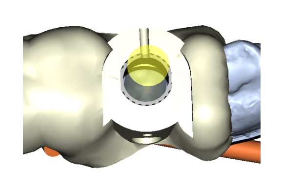 Dental implant guided surgery
