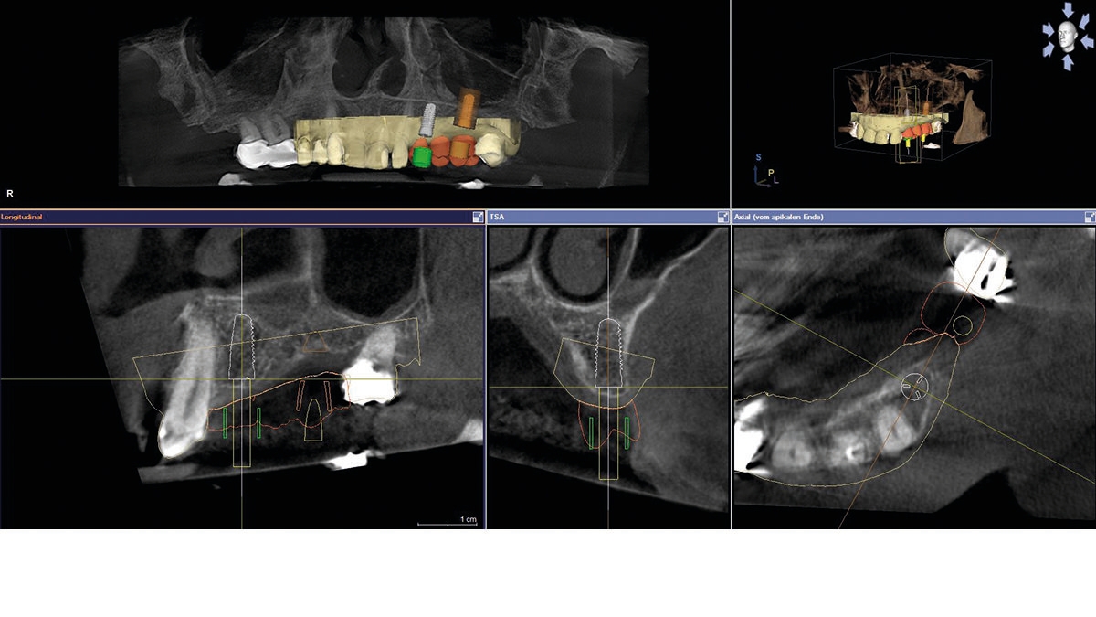 inLab CAD Software, optical scan in combination with 3D X-ray data