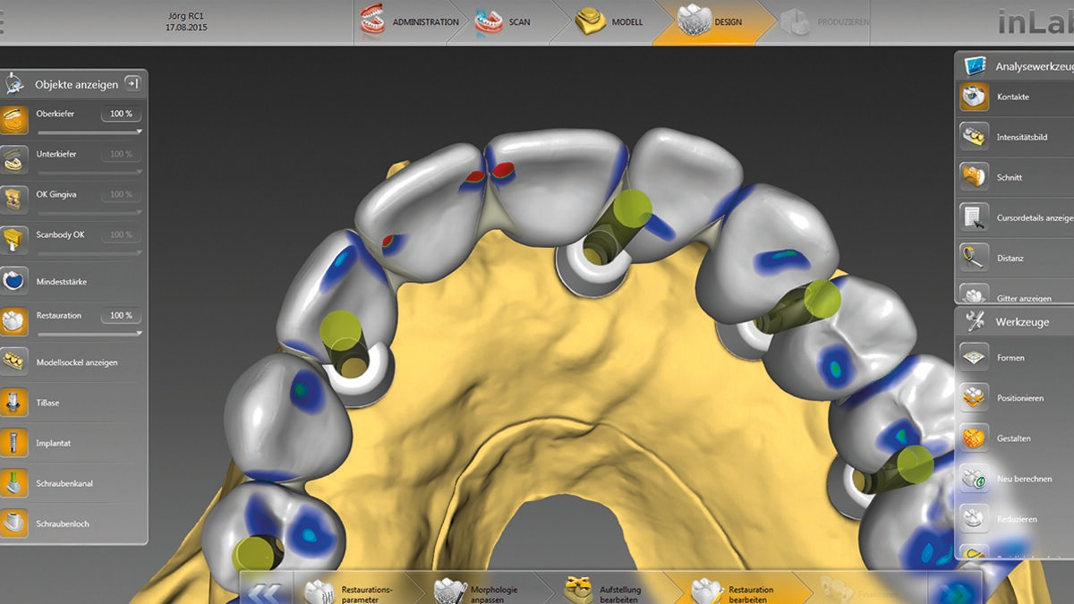 inLab CAD Software, superstructure construction