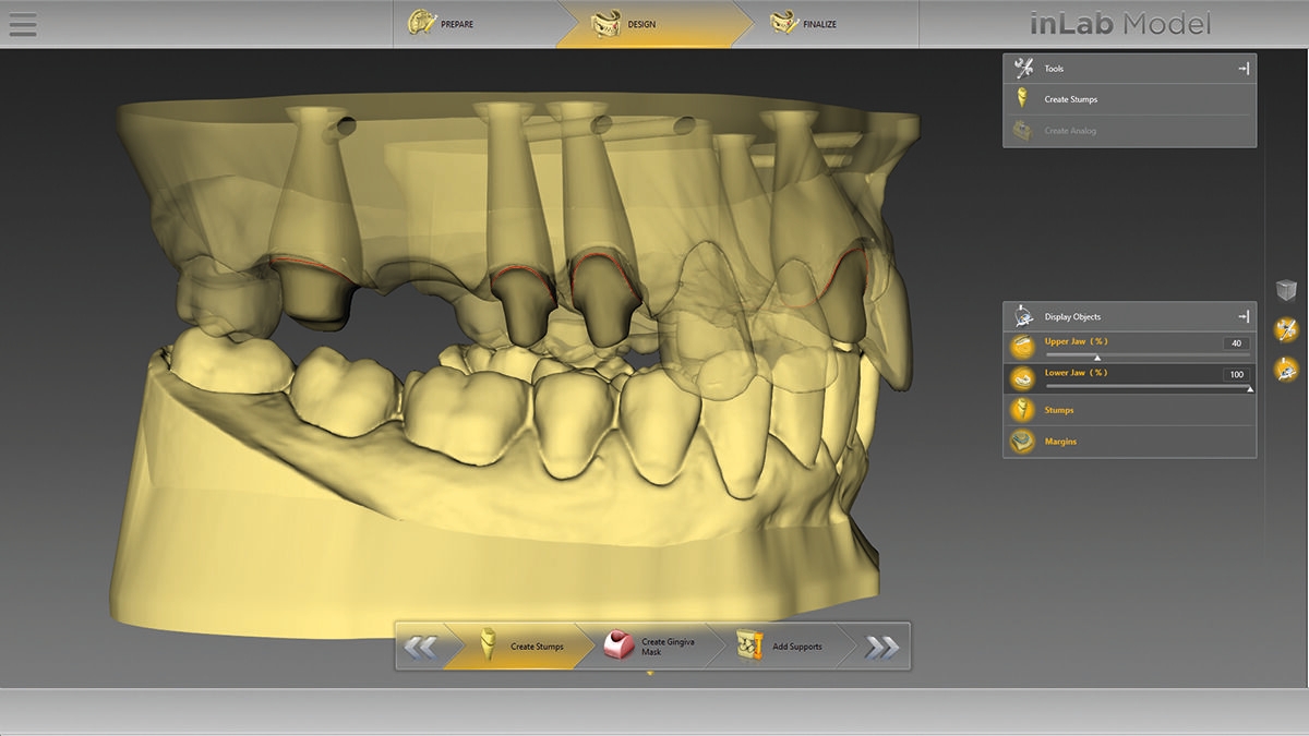 inLab CAD Software, Virtual data model, preparation margins