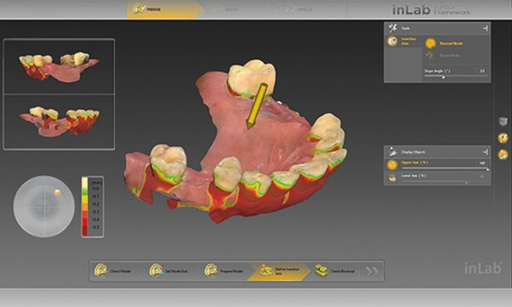 inLab CAD Software, display of undercuts
