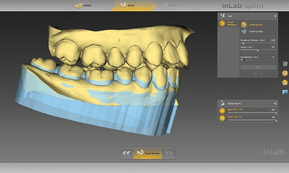 inLab CAD Software, undercuts are blocked