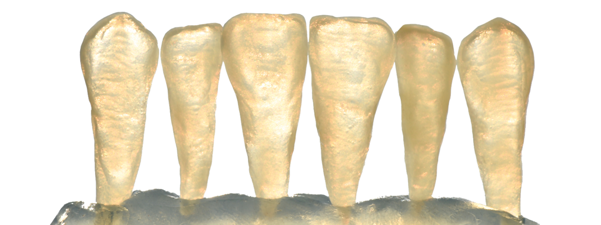 Opalescence of Celtra Press in anterior