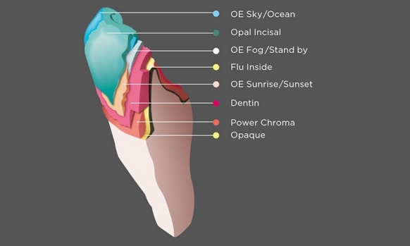 Custom build-up technique in the anterior with Kiss ceramic veneering