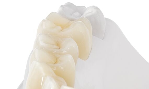 All Ceramic Crowns & Bridges