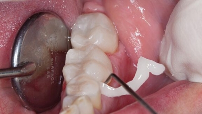 Easy cleaning image, showing the removal of excess cement