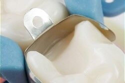 class II dental restoration matrix placement of Palodent Plus sectional matrix by Dentsply Sirona where the tooth has a natural convex contour