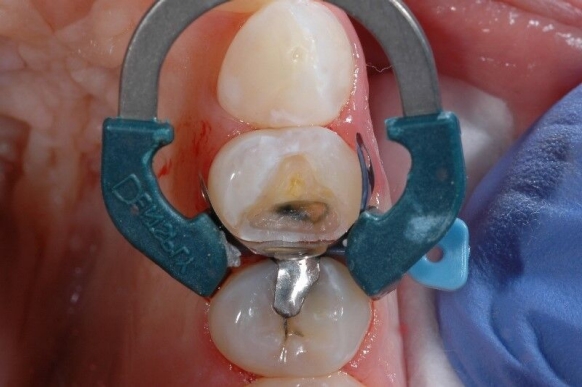 Use of palodent plus sectional matrix system with plastic wedge