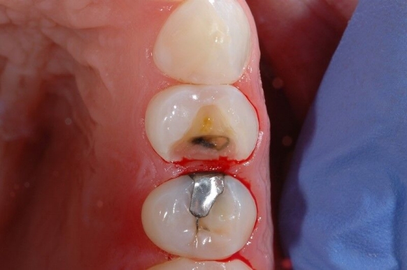 Image of bleeding after using a wooden wedge