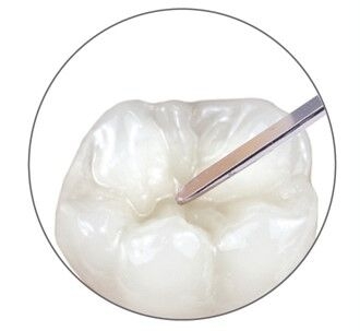 CeramX Spectra ST tooth modelling
