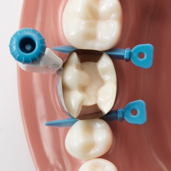 Versatile placement of Palodent 360 option 2