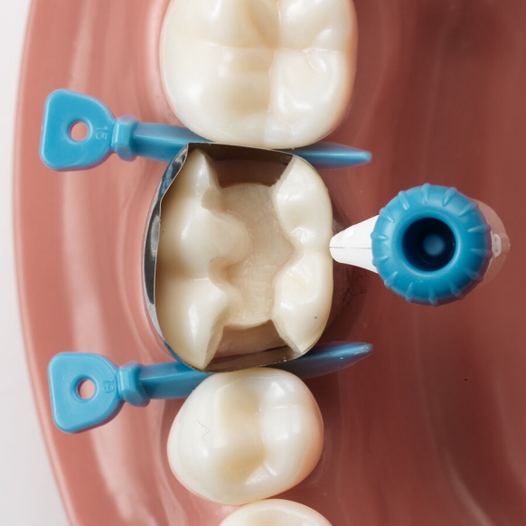 Versatile placement of Palodent 360 option 5