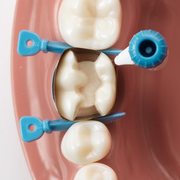 Versatile placement of Palodent 360 option 6