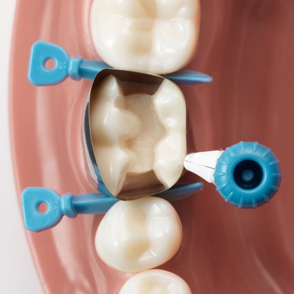 Versatile placement of Palodent 360 option 4