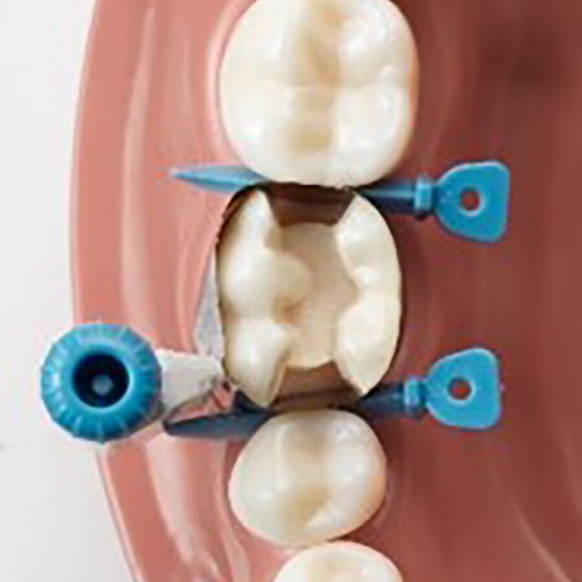 Versatile placement of Palodent 360 option 3
