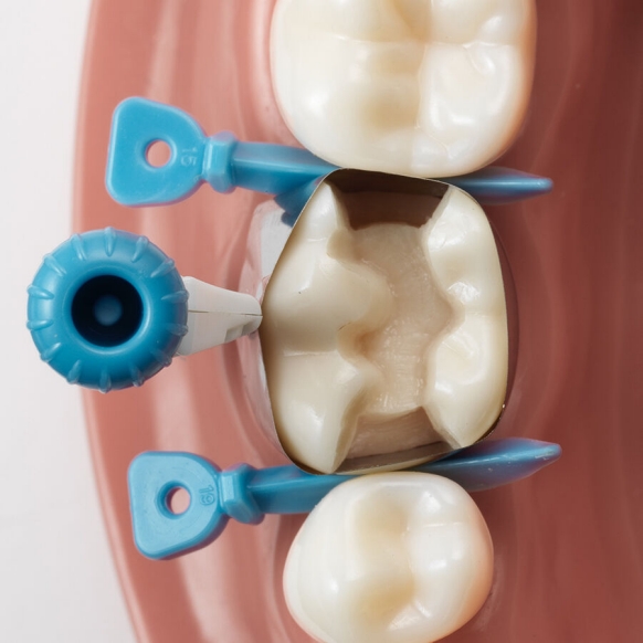 Versatile placement of Palodent 360 option 1