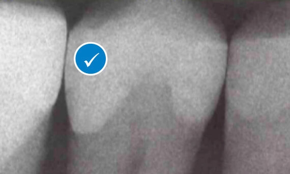 Better outcome with Palodent matrix system restoration
