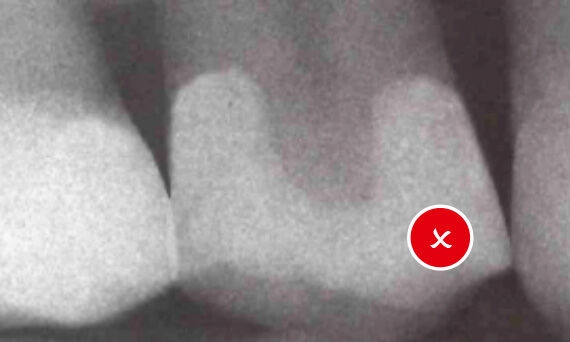 Outcome with Tofflemire circumferential band restoration