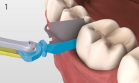 Placing a Palodent V3 Wedge or WedgeGuard with Pin-Tweezers