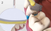 Using Pin Tweezers to detach the shield from WedgeGuard