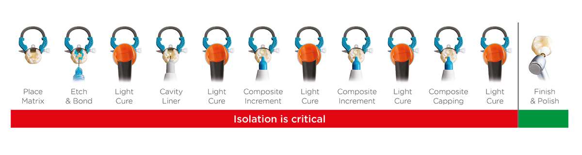 Surefil one workflow showing contamination risk