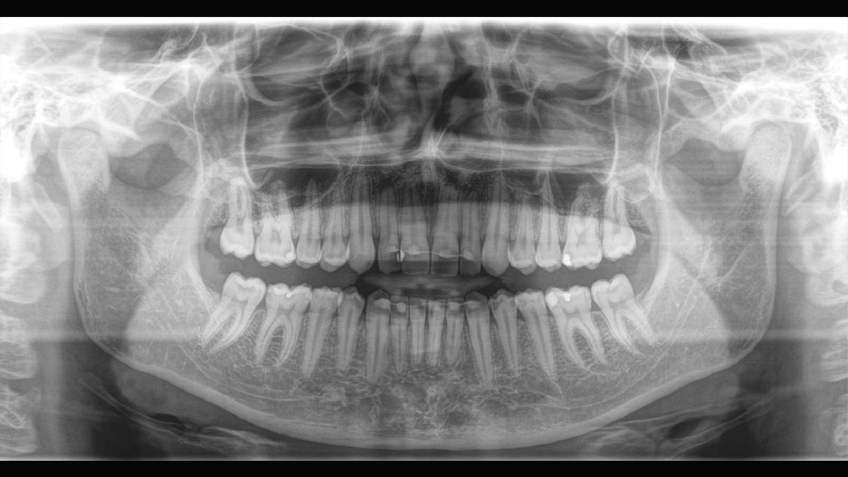 Orthophos SL 2D Bitewing