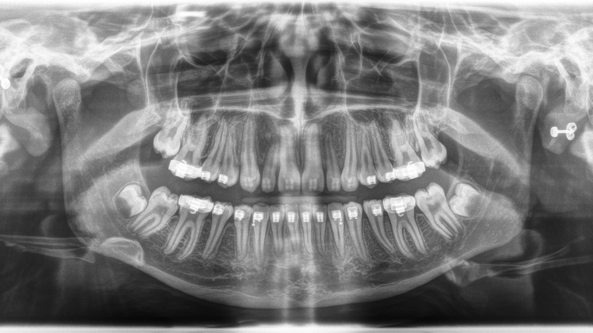 Orthophos XG 3D. Caso Clínico