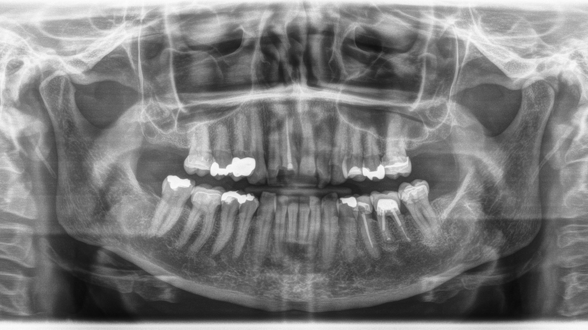 Orthophos XG 3D. Caso Clínico 2