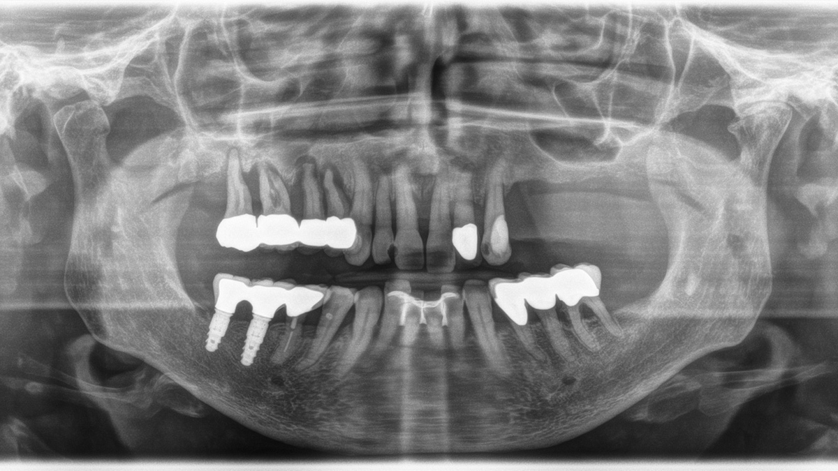 Orthophos XG 3D. Caso Clínico