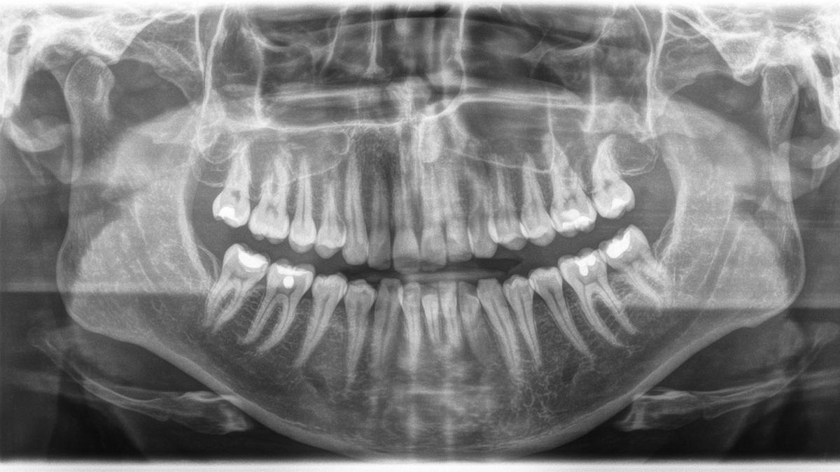 Orthophos XG 3D. Caso Clínico