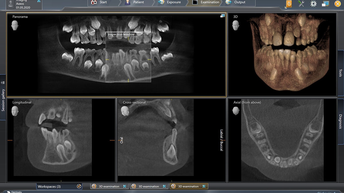 X-ray of digital dental unit Axeos 