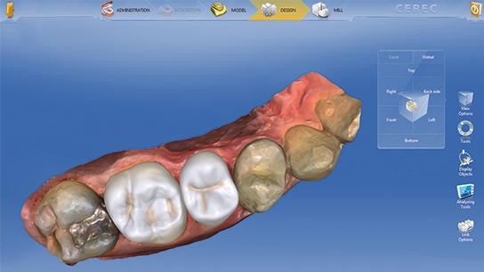 Restoration proposal of CEREC software