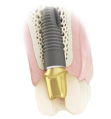 Atlantis Screw-retained solutions